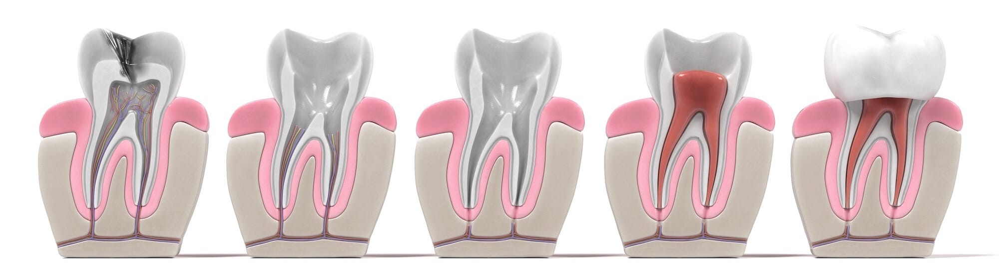 Evo root canal